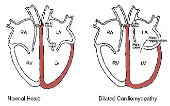 Dilated Cardiomyopathy